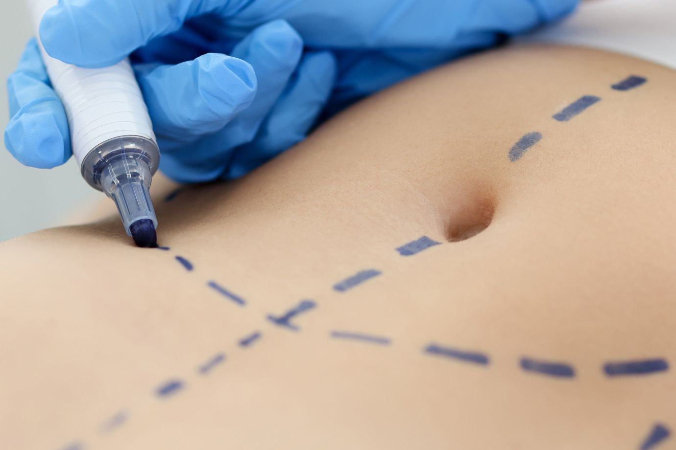 Abdominoplastia em goiânia