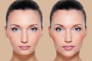 Implante de mandíbula em Goiânia