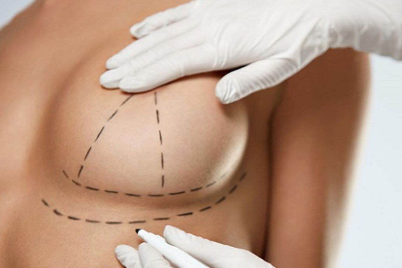 Mastopexia em Goiânia