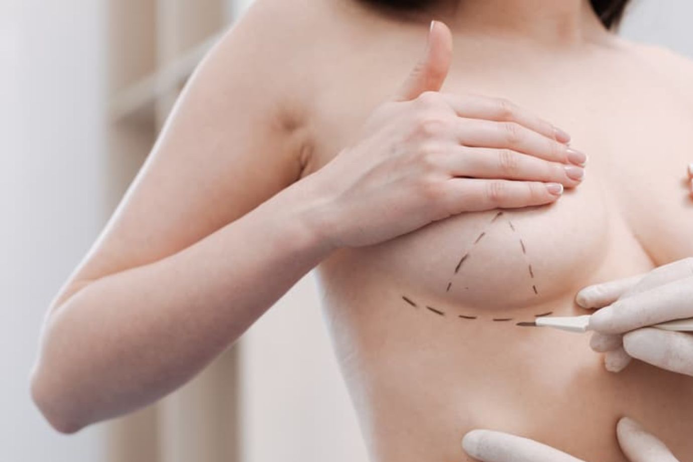 Reconstrução Mamária em Goiânia