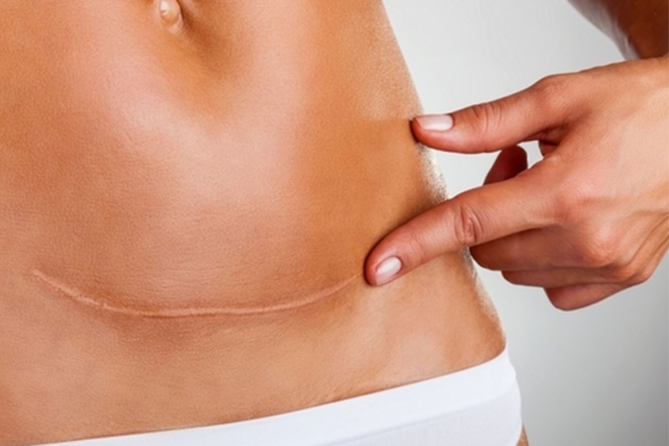 Correção de Cicatriz em Goiânia