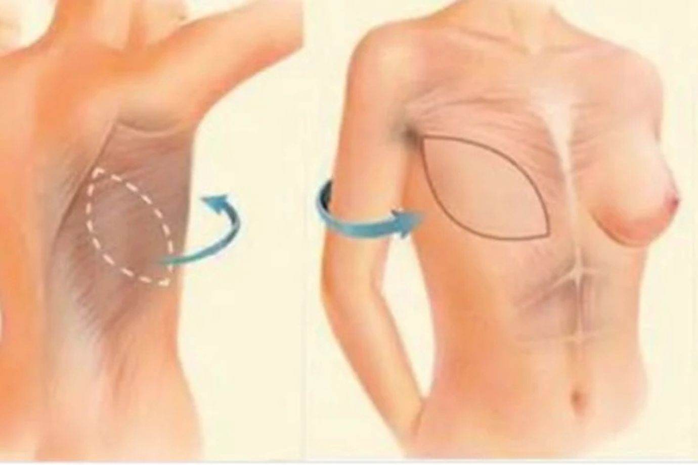 Expansão de Tecido em Goiânia