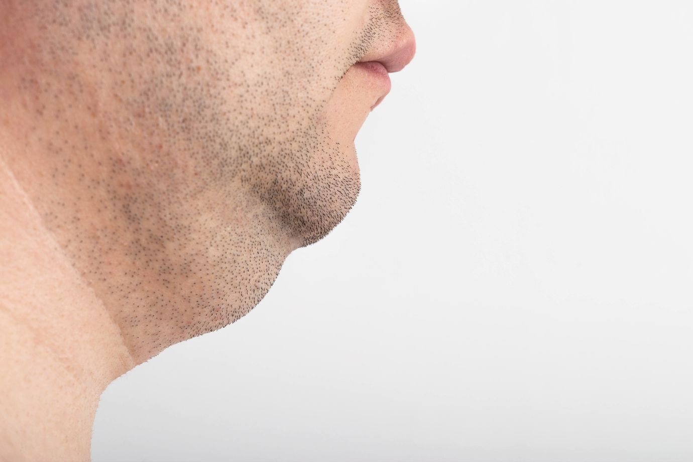 Cirurgia de Papada em Goiânia