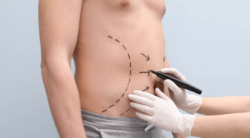 Abdominoplastia Masculina em Goiânia